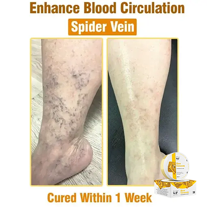 ✅Official Store:flysmus™ Bee Venom Treatment Cream👨‍⚕️FDA Certification(💝 Helps with Eczema, Psoriasis, Acne, Rosacea, Fungal Infections, and Warts💝)