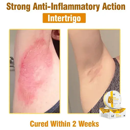 ✅Official Store:flysmus™ Bee Venom Treatment Cream👨‍⚕️FDA Certification(💝 Helps with Eczema, Psoriasis, Acne, Rosacea, Fungal Infections, and Warts💝)