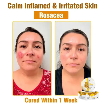 ✅Official Store:flysmus™ Bee Venom Treatment Cream👨‍⚕️FDA Certification(💝 Helps with Eczema, Psoriasis, Acne, Rosacea, Fungal Infections, and Warts💝)